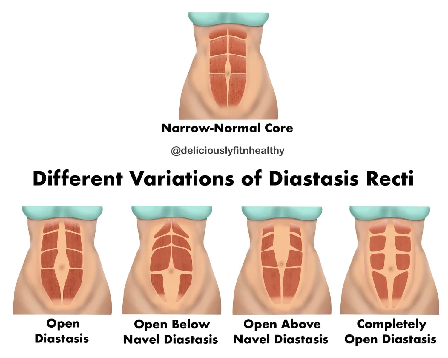 Illustration comparing a narrow-normal core with four variations of diastasis recti: open diastasis, open below the navel, open above the navel, and completely open diastasis