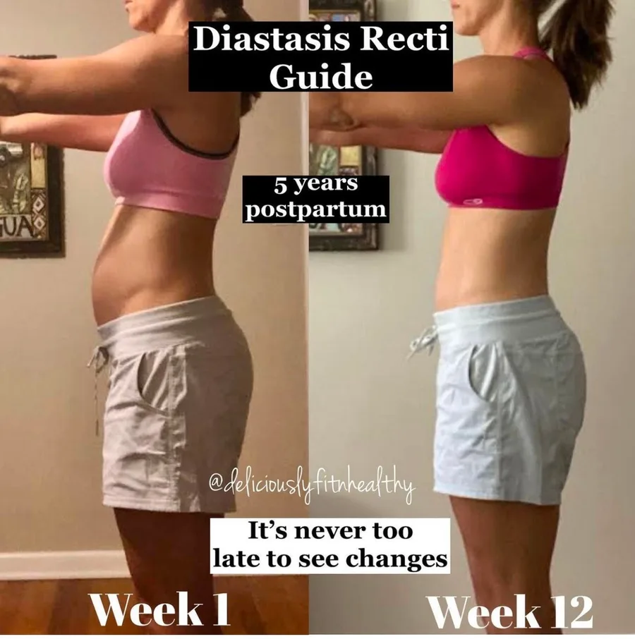 Tara's week 1 to week 12 side-profile progress on the DR Core Guide, five years postpartum